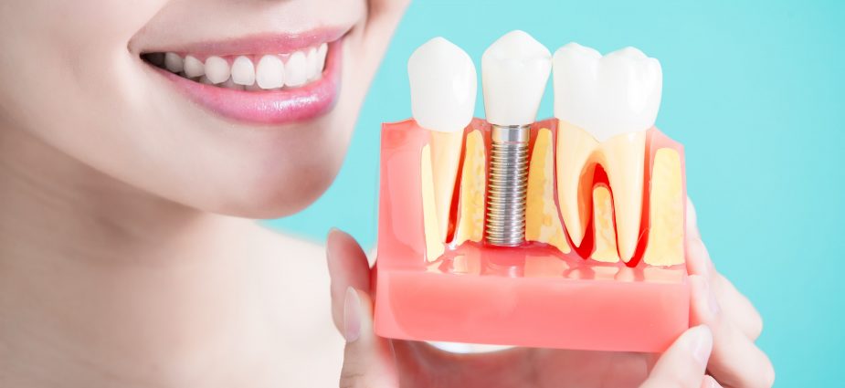 What It’s Like Getting a Dental Implant