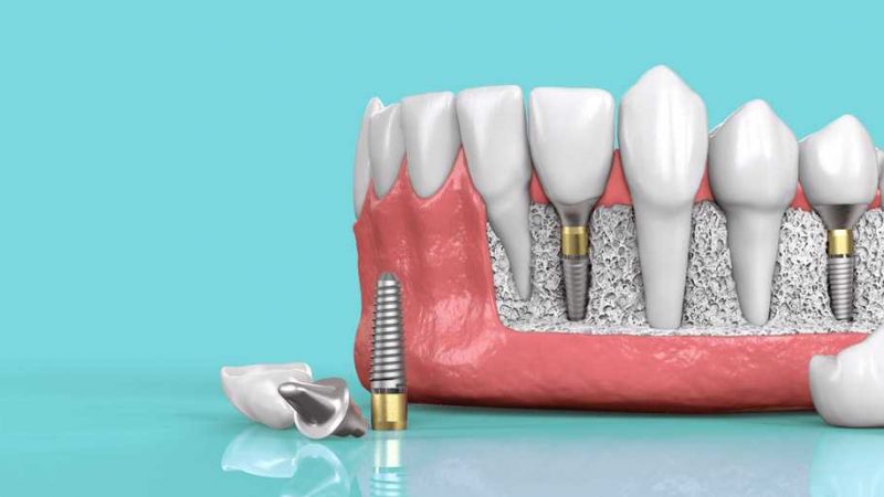 Why Should You Consider Getting A Dental Implant?