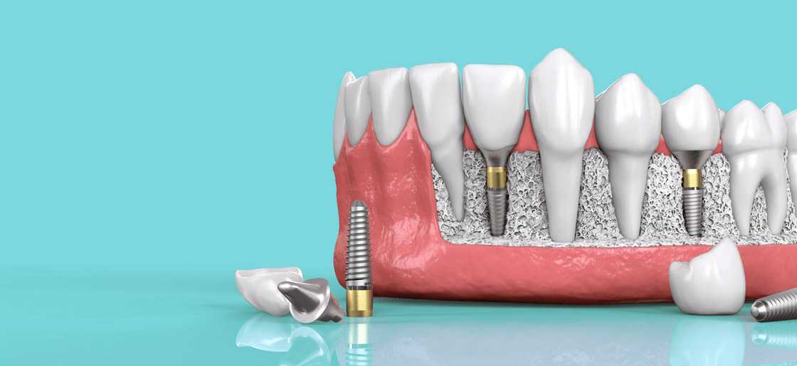 Why Should You Consider Getting A Dental Implant?